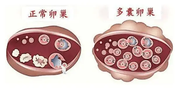 安徽中醫藥附屬劉忠燕主任:多囊卵巢的“食療祕籍”